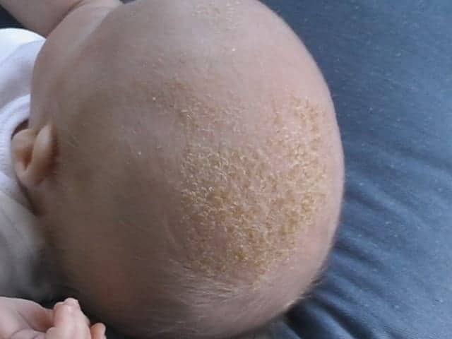 Tips And Treatment For Baby Dry Scalp In 2018 Kids Saver Network